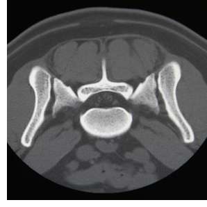 Lumbar CTWeb