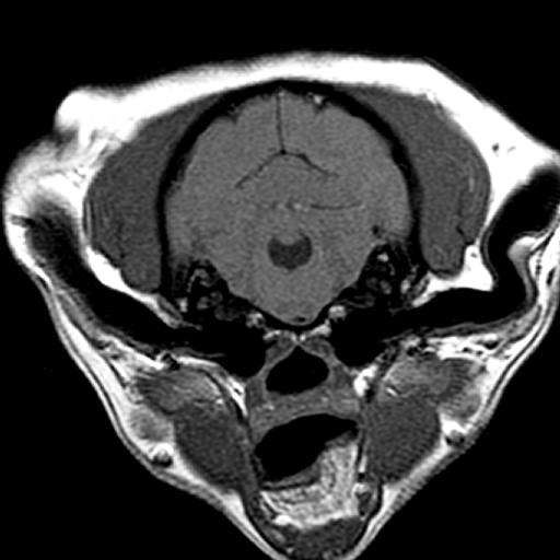 Axial T1 MRI no contrast